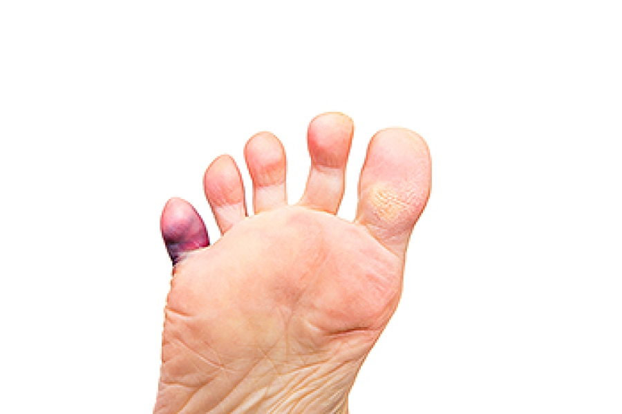 Symptoms of a Broken Toe